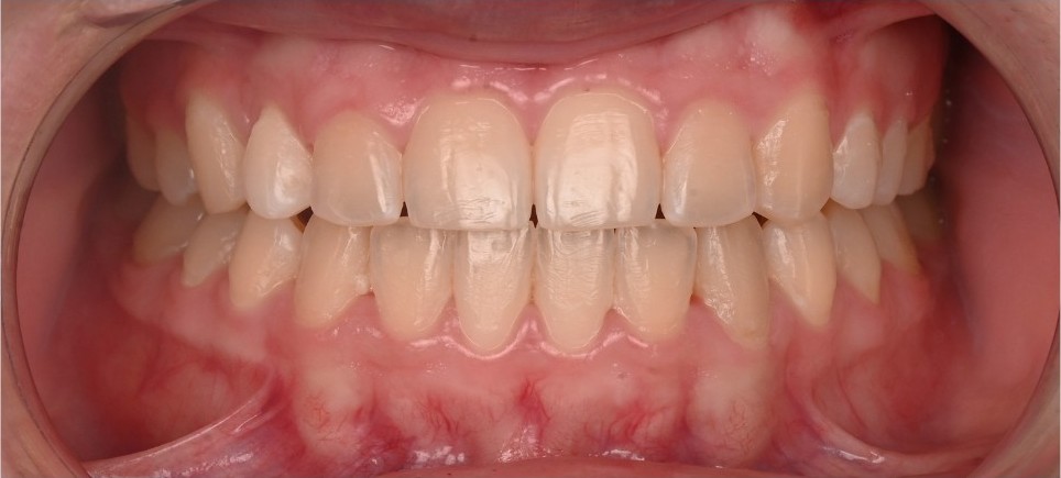 First premolar moved into the canine position and reshaped after treatment