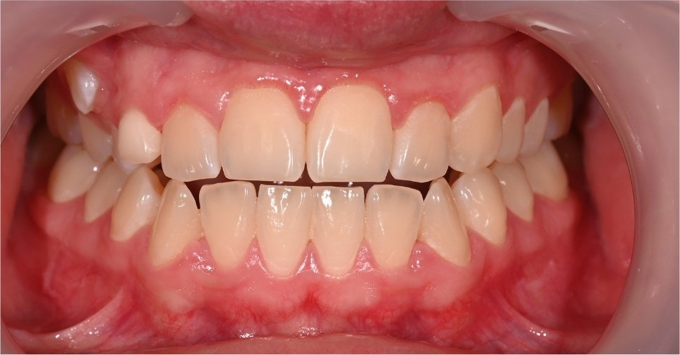 Bite before treatment, with the arches to be aligned and space to be opened for the missing lower molar